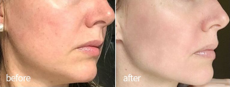 琚佸濮楁帹鑽愯憽钀勭苯鎶よ偆,琚佸濮楄憽钀勭苯绮惧崕