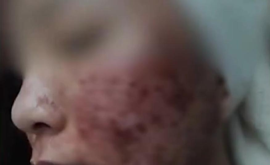 美容会所打瘦脸针险致毁容,注射瘦脸针不当导致感染毁容