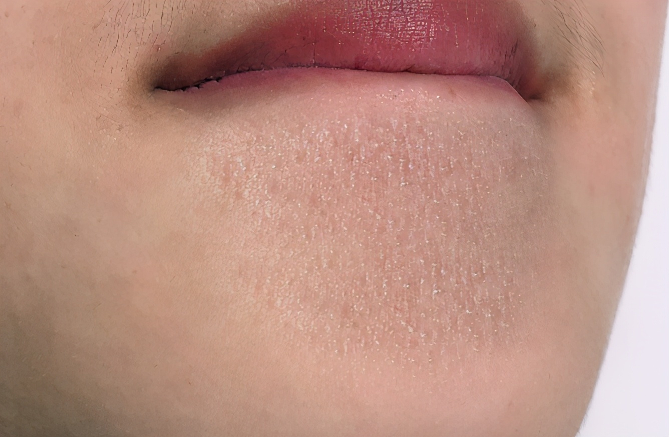 下巴和鼻翼白色的小粉刺,鼻子下巴白色粉刺