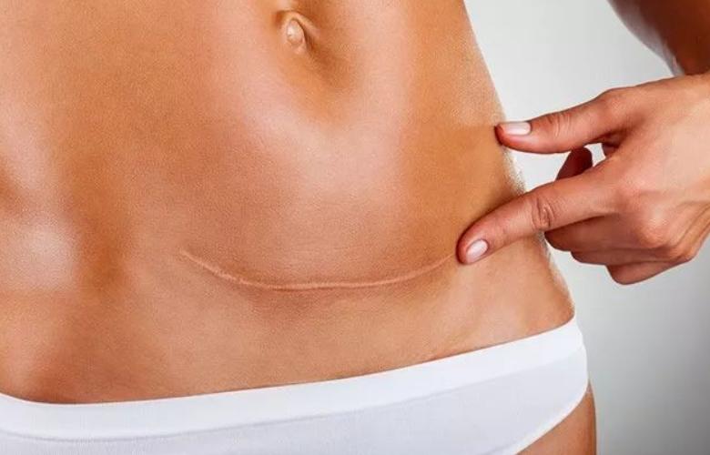 剖腹产四胎有哪些后遗症,剖腹产10种后遗症