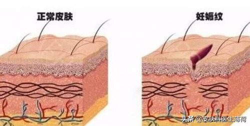 妊娠后皮肤痒,孕早期长痘化妆品能用吗