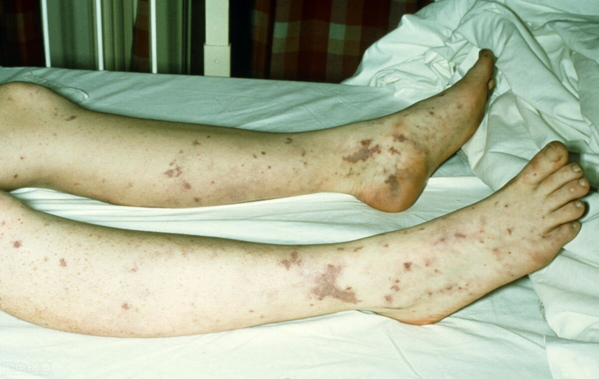 过敏性紫癜小腿有淤斑怎么办,过敏性紫癜形成瘀斑按压疼痛吗