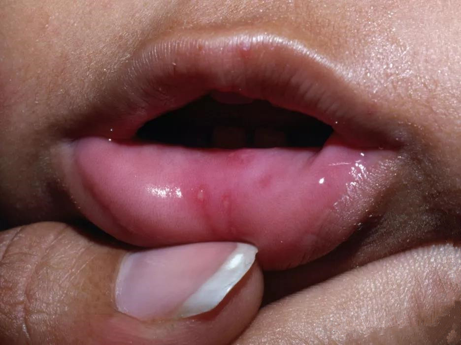 手足口病后期痊愈症状是什么,手足口病症状消失一般多少天