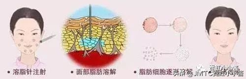 记录翻译小姐姐日本打溶脂针，肉脸变骨感脸全过程｜日本医美