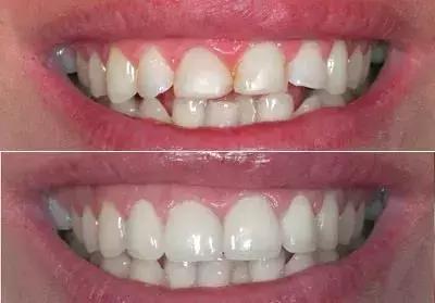 怎么才能真正有效的美白牙齿,最快最有效美白牙齿的方法