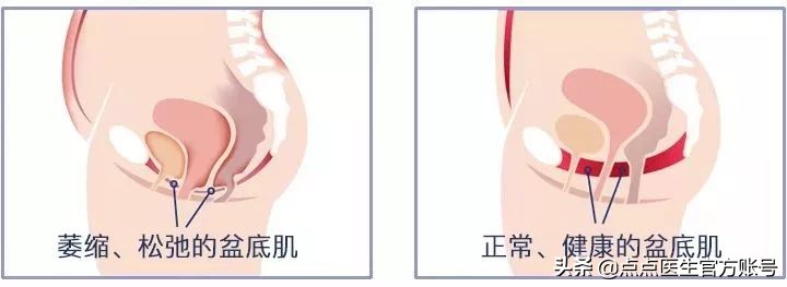 产后修复不好好做,产后不重视修复会有什么后果