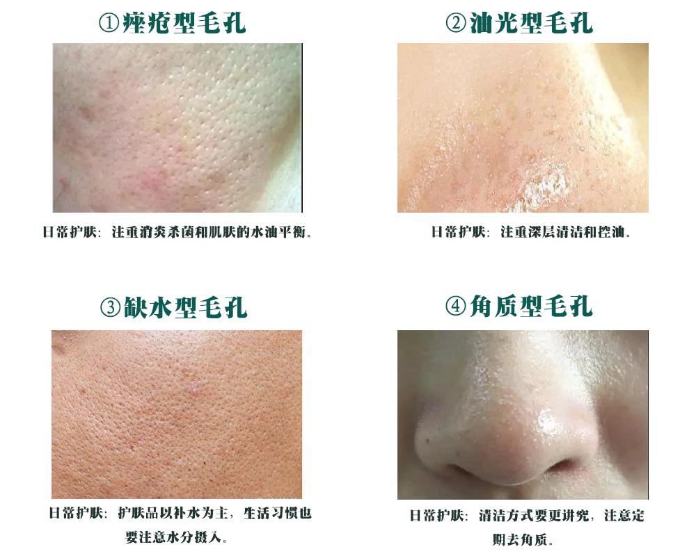 改善毛孔黑头粗大的小窍门,如何改善黑头毛孔粗大闭口