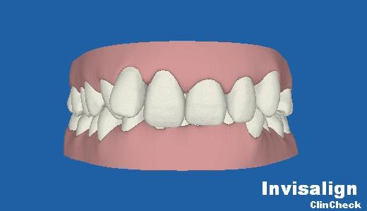 隐形牙套的效果和钢牙效果一样吗,传统牙套和隐形牙套哪个效果好