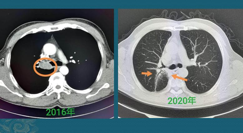 癌症发现就是晚期还有必要体检吗,有些癌症不治没事一治就完了