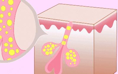 毛孔粗大的原因及改善方法,毛孔粗大的原因和治疗方法