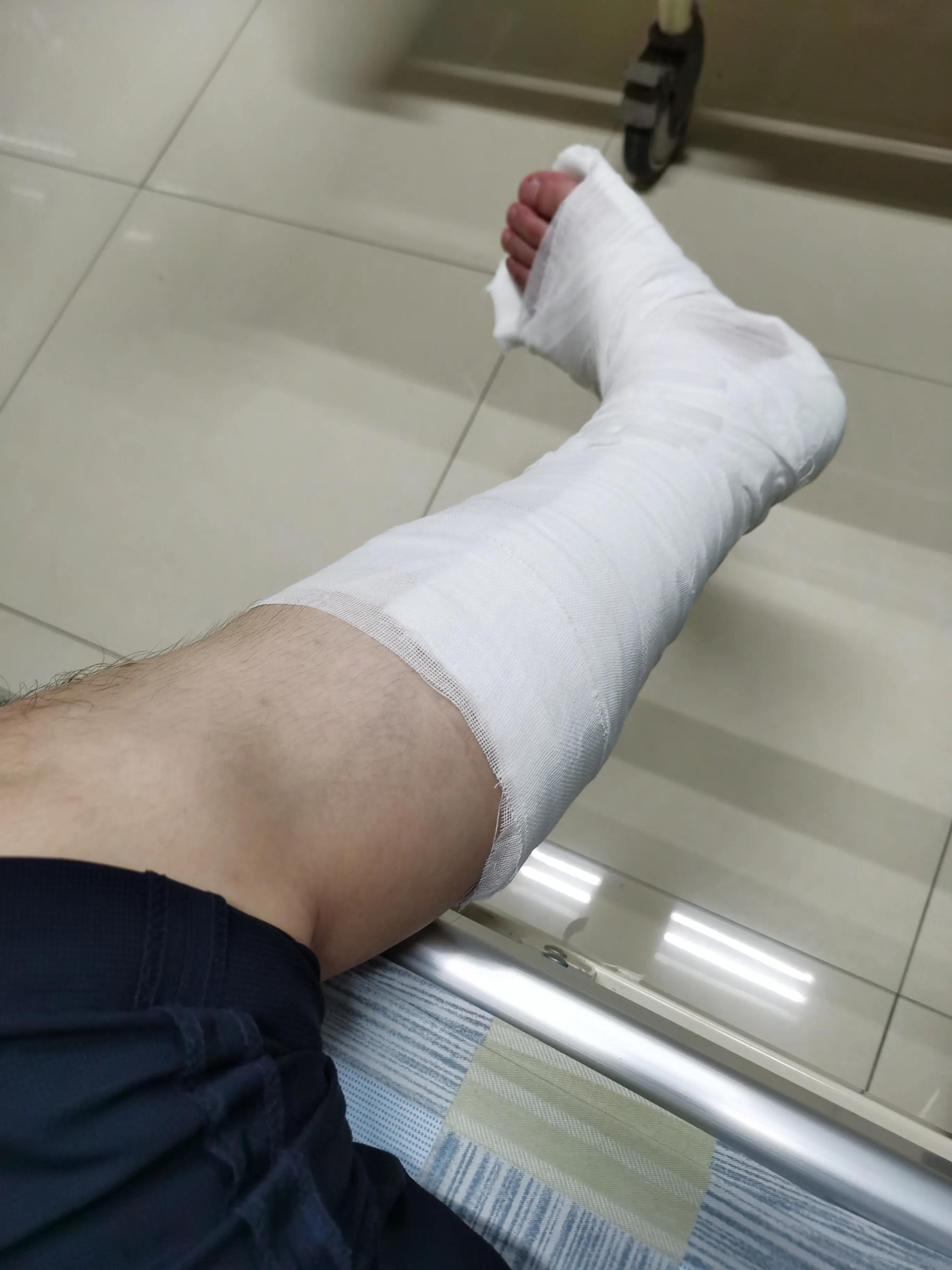 第五跖骨粉碎性骨折多久后能走路,第五跖骨基底骨折100天了走路肿