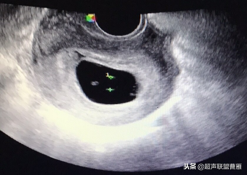 内见卵黄囊,卵黄囊肿瘤