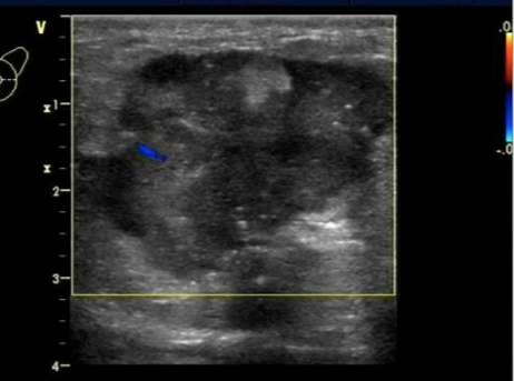 乳腺恶性肿瘤彩超表现,乳腺结节良性恶性彩超对照图