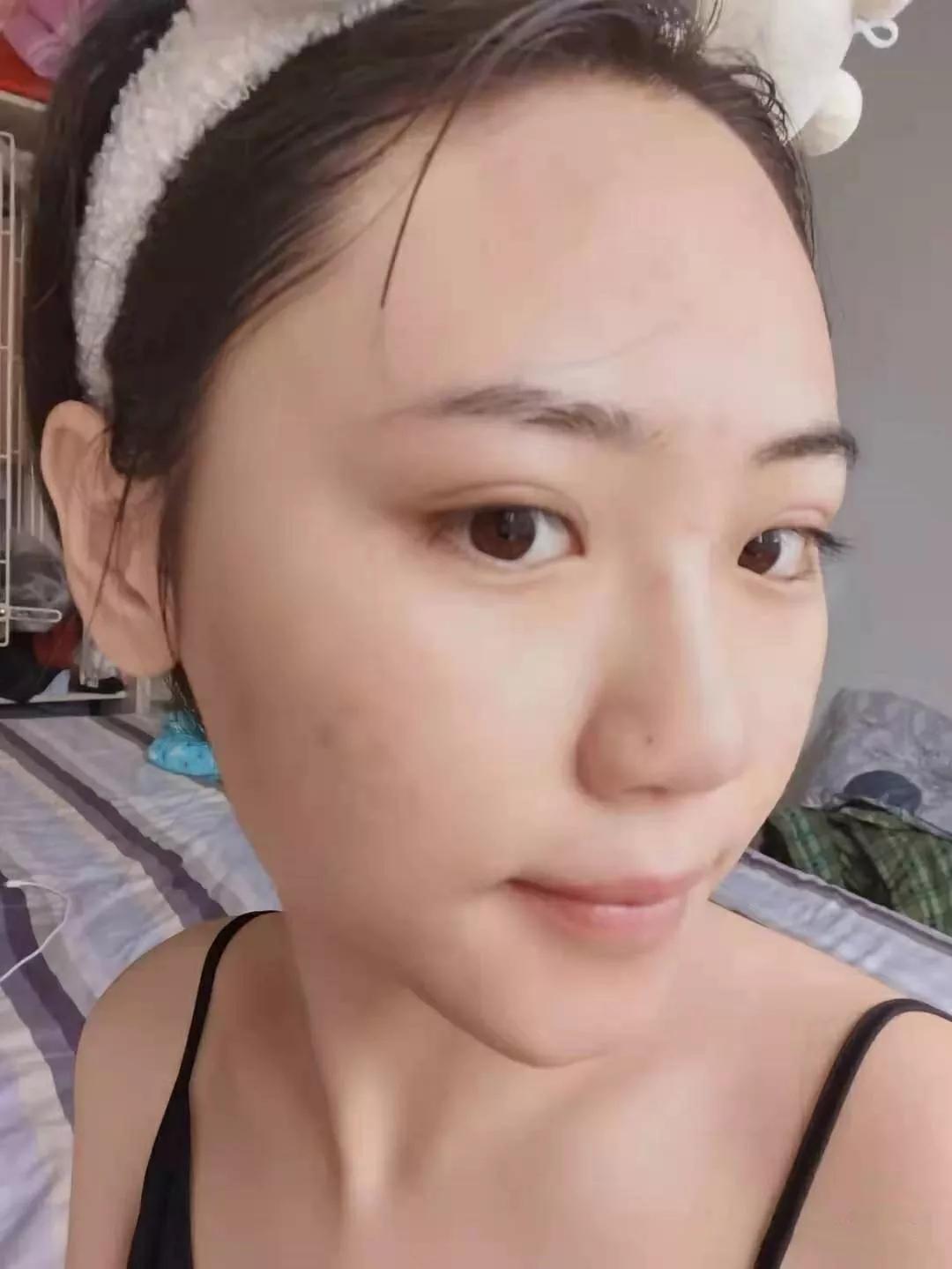 北京看痘痘好的皮肤科医院,去皮肤科看痘痘好不好