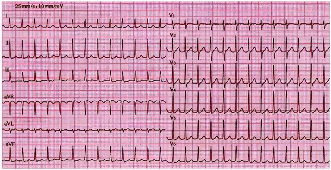 心脏彩超和动态心电图哪个准确,心电图跟心脏彩超哪个更准确