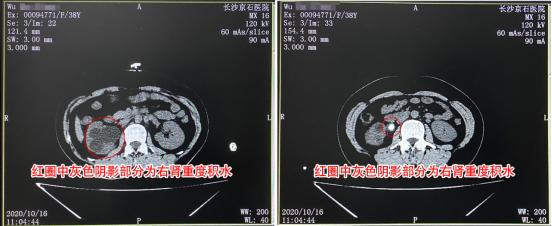 张医生提醒秋冬谨防肾结石,肾结石要及时治疗吗
