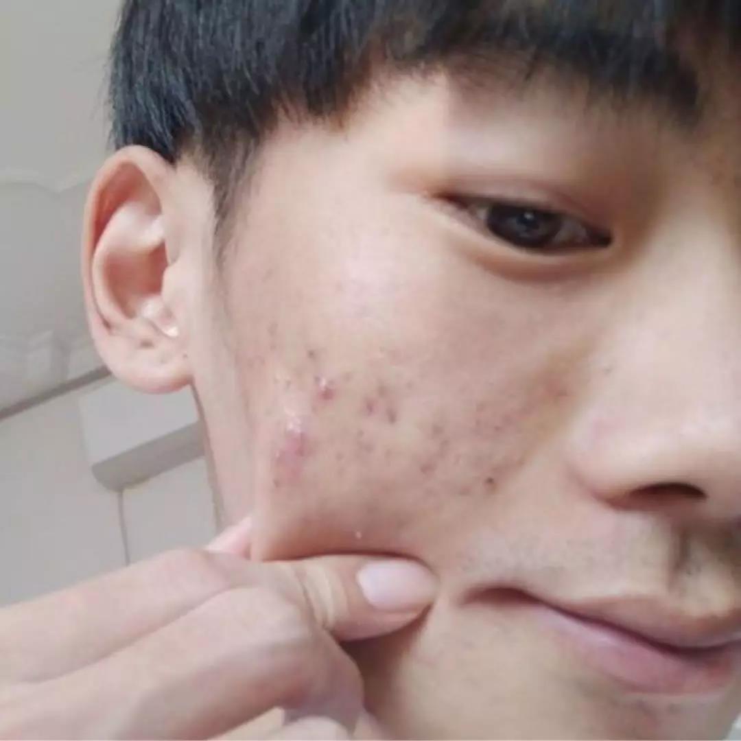 如何快速祛痘去痘印小妙招,怎样可以祛痘痘和痘印最有效
