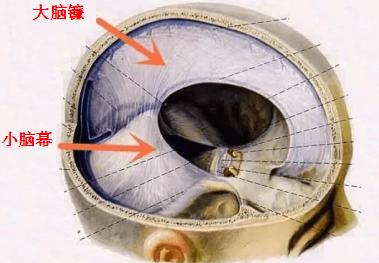 脑血管堵塞手术是大手术吗,脑血管堵塞要开颅手术吗