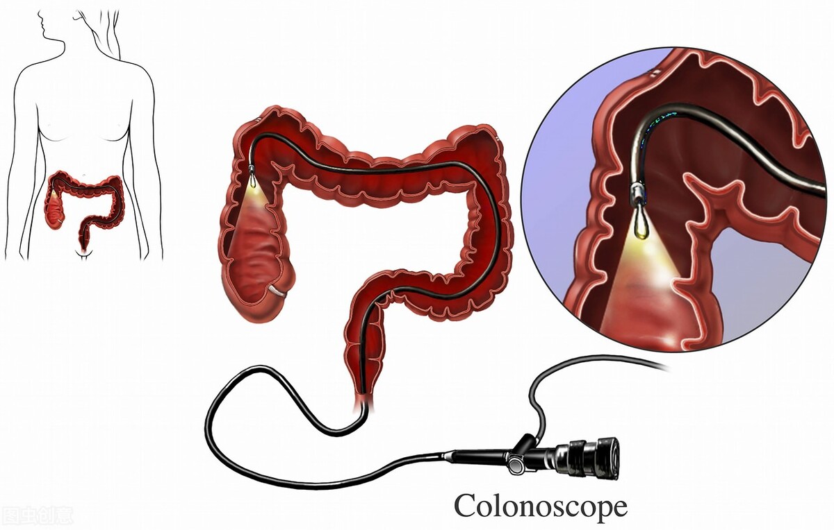 胃肠镜检查之前，该注意些什么？