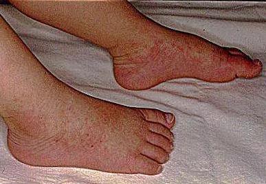 哪些国家有儿童感染新冠病毒的,现在新冠病毒儿童最新症状