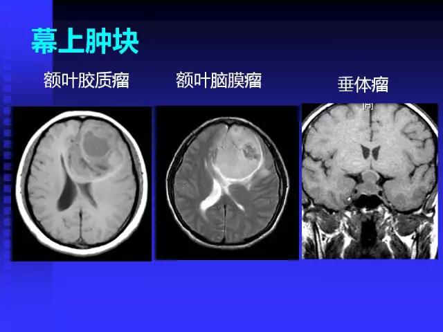 头颅mri读片视频教程,颅脑mri读片入门教程视频讲解全集