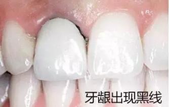 烤瓷牙和全瓷牙的优缺点是什么,钴铬合金烤瓷牙和全瓷牙优缺点