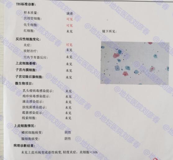 tct炎症反应性细胞改变需要治疗吗,宫颈tct显示重度炎症需要治疗吗