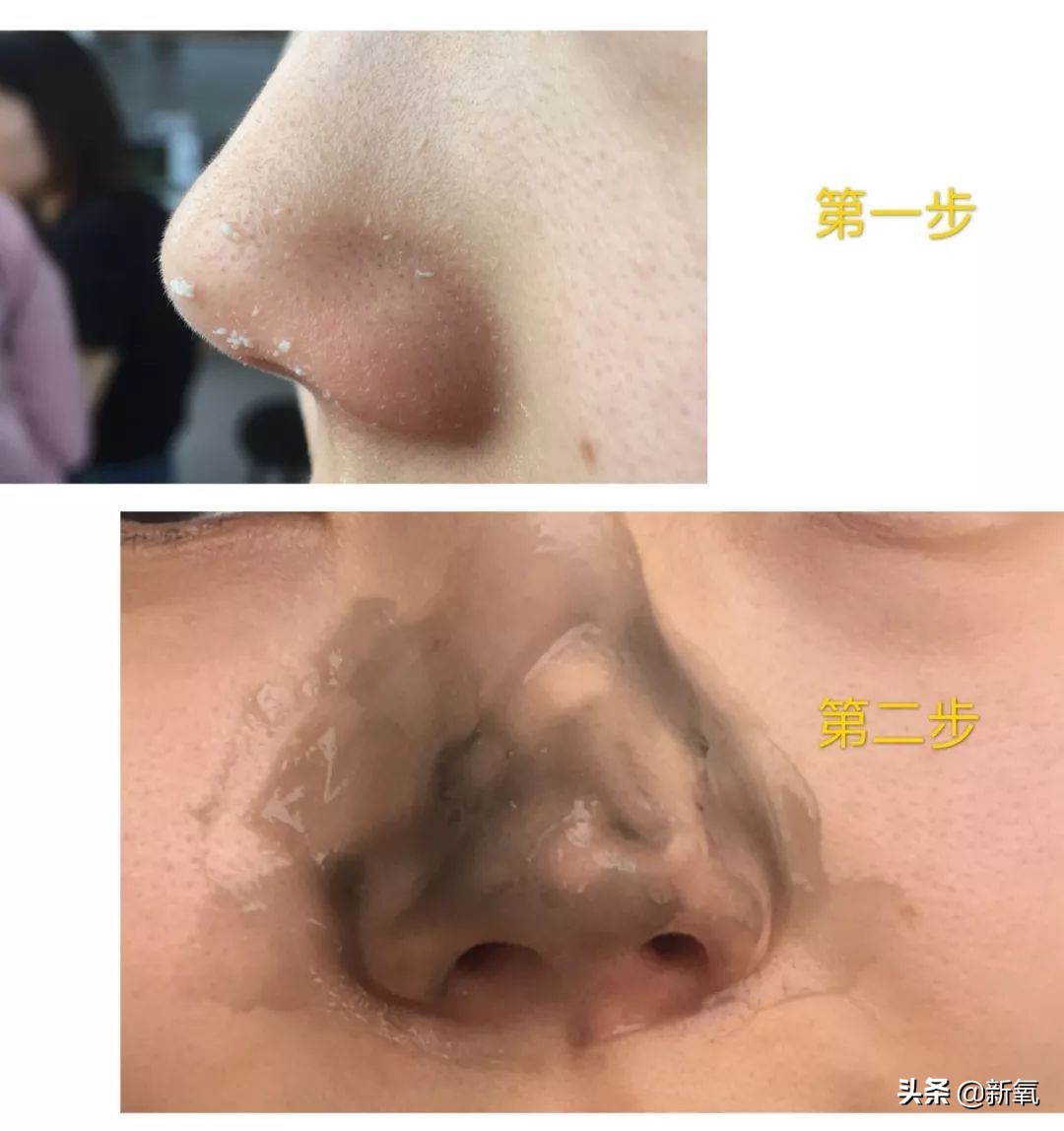 亲测非常有效的去黑头方法,去黑头最有效的方法三天见效