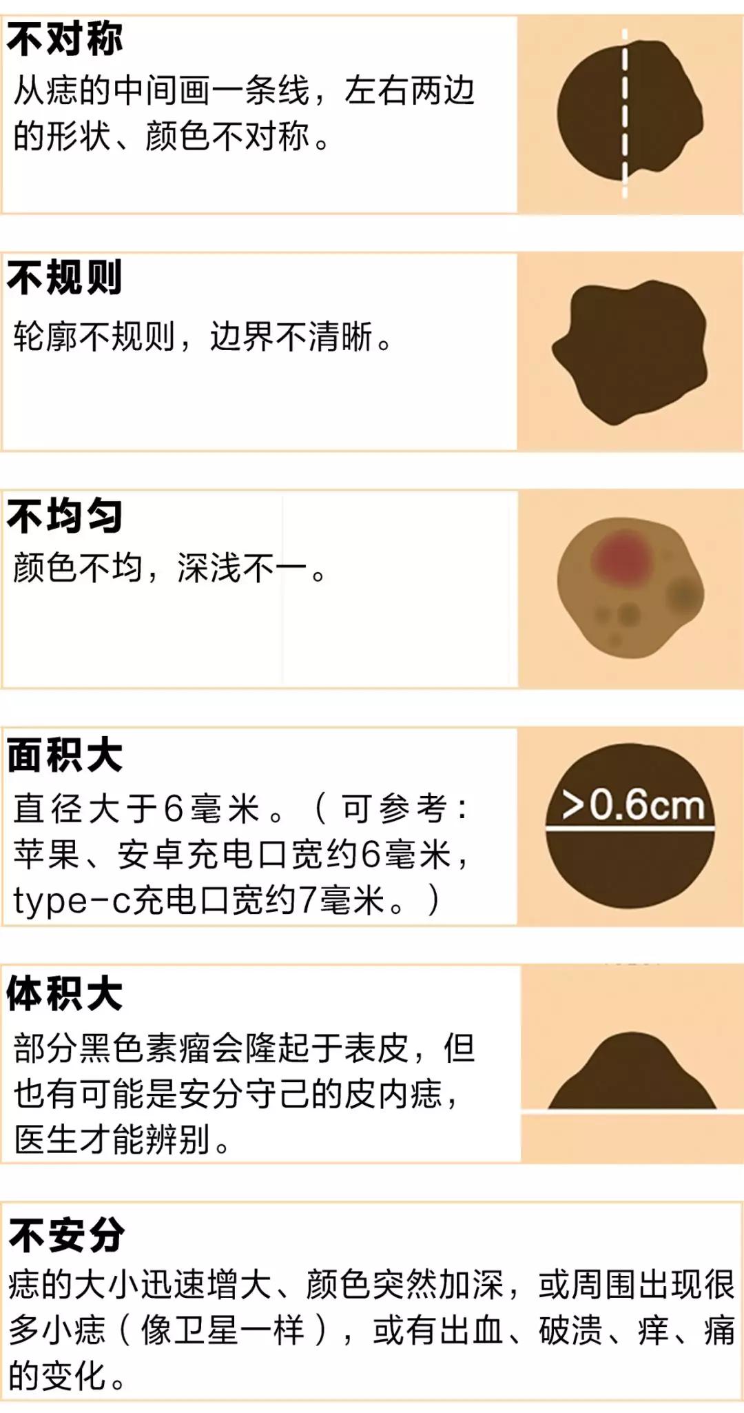 长在什么部位的痣最危险,长在哪些部位的痣需要特别注意