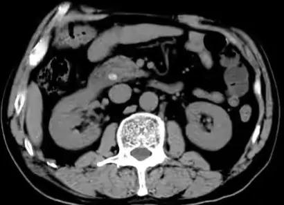 面黄眼黄尿黄是什么原因,眼黄尿黄吃什么好