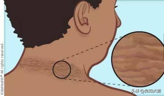 糖尿病脖子后面发黑的症状,脖子皮肤像鸡皮是糖尿病么