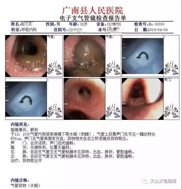 吓人！广南一男子气管内发现6厘米蚂蟥，文山人注意了……