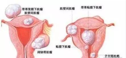 子宫肌瘤月经不干净中药治疗,中药调理子宫肌瘤月经不调