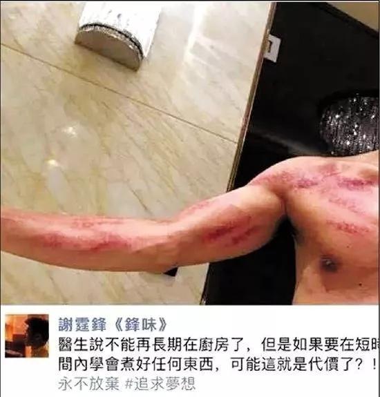 骨科专家讲述筋膜炎治疗视频,骨科大夫治疗筋膜炎