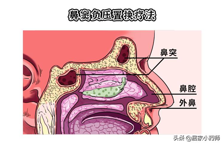 做前列腺理疗具体是怎么操作的,去医院做前列腺理疗怎么做