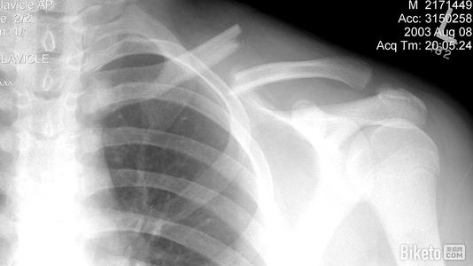 锁骨骨折为啥有人恢复快有人慢,锁骨骨折十大后遗症