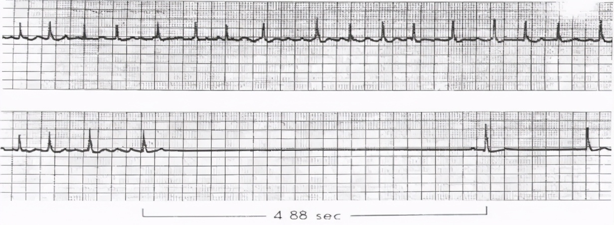 心脏彩超和动态心电图哪个准确,心电图跟心脏彩超哪个更准确
