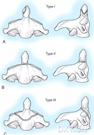 所有骨折都叫什么名字,骨折的名称有哪些