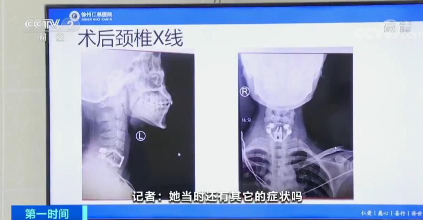 90后女孩蹦床馆摔成完全性截瘫,小女孩玩蹦床导致截瘫