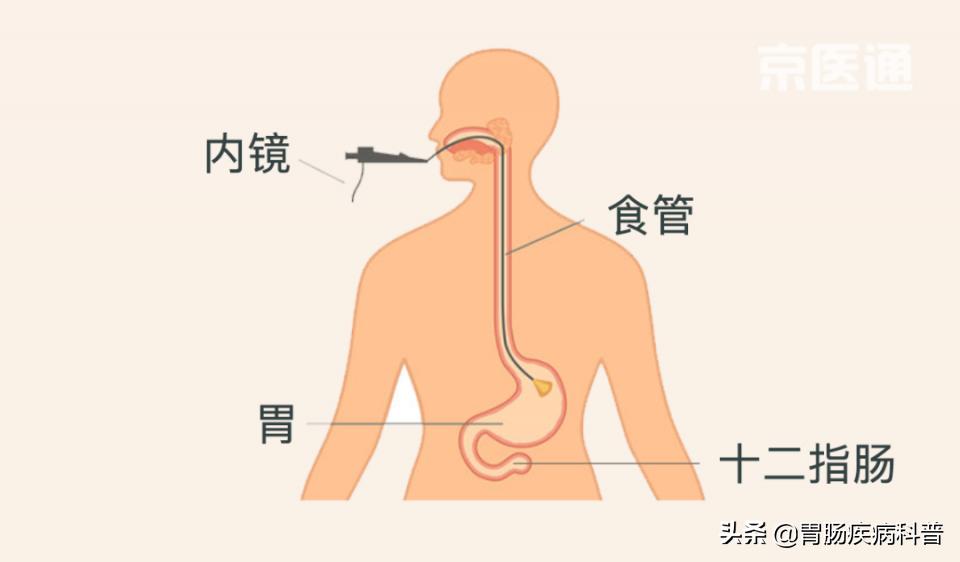 肠胃镜报告要等多久,教你3分钟看懂胃镜活检病理报告