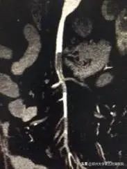 房颤患者的噩梦之不一样的急性腹痛——肠系膜上动脉栓塞