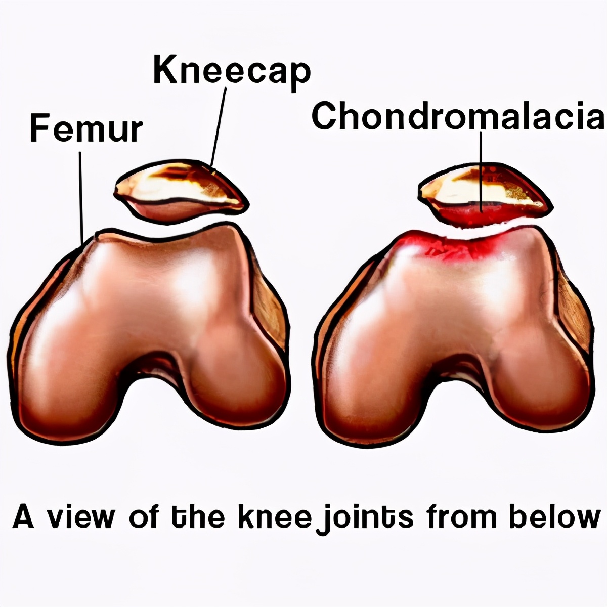 膝盖上楼发软无力但不疼痛怎么办,膝盖无力走楼梯发软是怎么回事