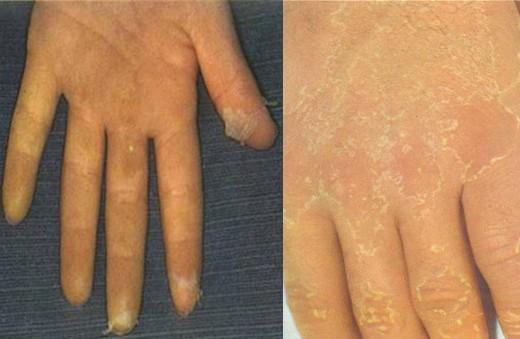 有发热和皮疹别忽视猩红热,猩红热先出红疹后发烧