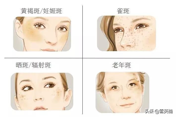 褐斑怎么除,褐斑怎么祛除最有效的方法