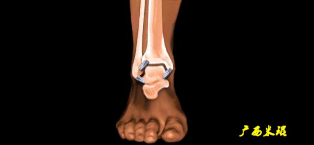 为什么踝关节扭伤容易崴脚,崴到脚踝关节扭伤怎么处理好得快