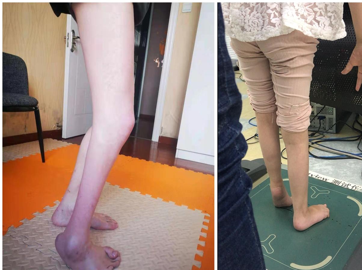 医院推荐儿童足外翻矫正鞋,脑瘫尖足矫正鞋