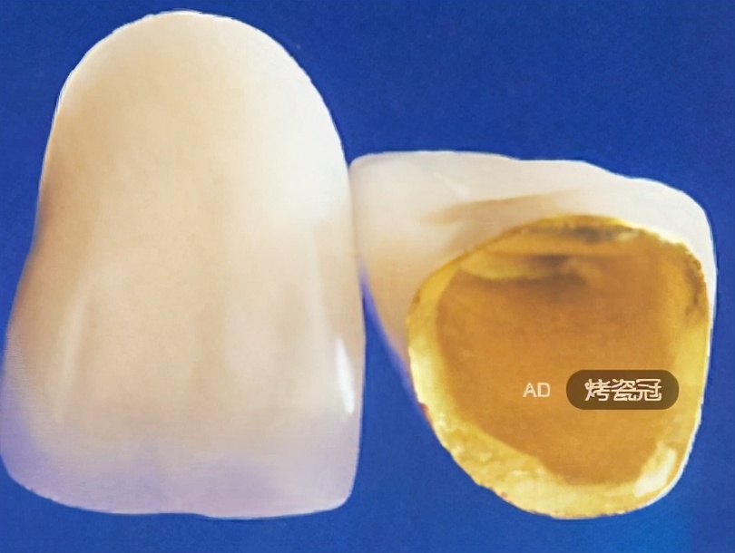 牙科全瓷冠与烤瓷冠有何区别,牙科中的临时冠和全瓷冠