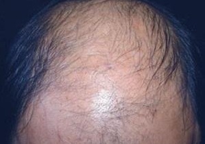 脱发掉的都是小绒毛是什么原因,脱发后头皮长出绒毛怎么办