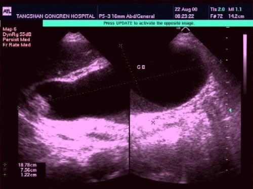胆囊壁毛糙可以确定是胆囊炎吗,b超显示胆囊壁欠光滑是胆囊炎吗