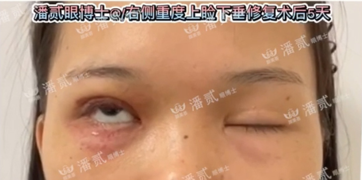 重度上睑下垂术后为什么闭不上眼睛？闭眼不全怎么护理好？